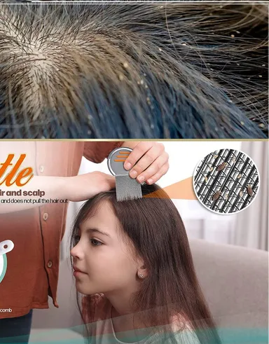 Faigy Lice Comb for Women and Kids | Stainless Steel Lice Terminator Fine Egg Nit Removal Comb | Scalp Louse and Eggs Remover (Pack of 2) thumbnail 2