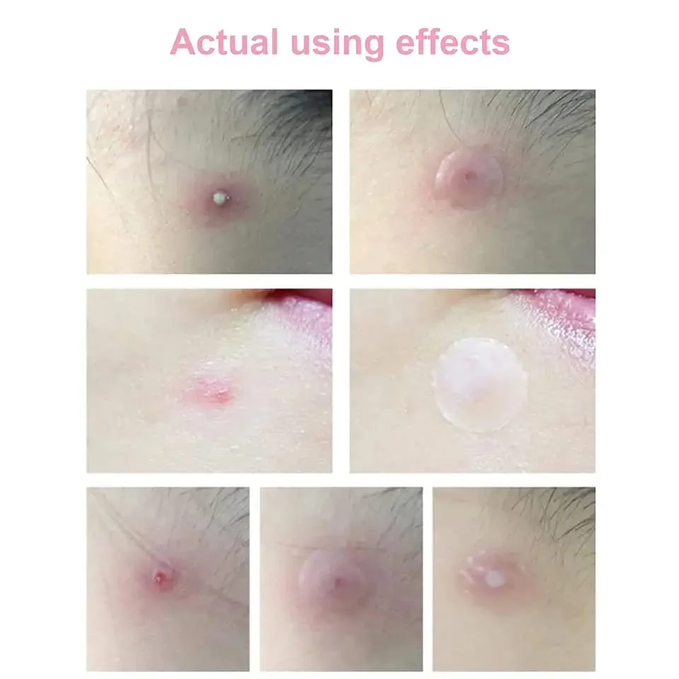 Invisible Hydrocolloid Pimple & Skin-Tag Patch Dots – 36-Pack Acne Spot Remover for All Skin Types (Face & Body) image 2