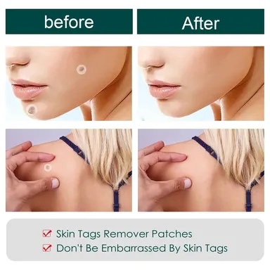 Invisible Hydrocolloid Pimple & Skin-Tag Patch Dots – 36-Pack Acne Spot Remover for All Skin Types (Face & Body) thumbnail 6