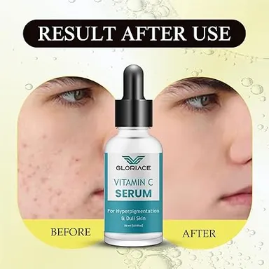 Vitamin C Face Serum for Hyperpigmentation & Dull Skin 30ml | Skin Brightening & Glowing Face Serum | Fades Dark Spots, Uneven Tone & Pigmentation | Antioxidant-Rich Daily Use Serum thumbnail 3