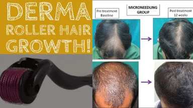 Derma Roller for Hair & Scalp Care' | Microneedle Scalp Massage Roller Helps Support Hair Growth Routine thumbnail 6